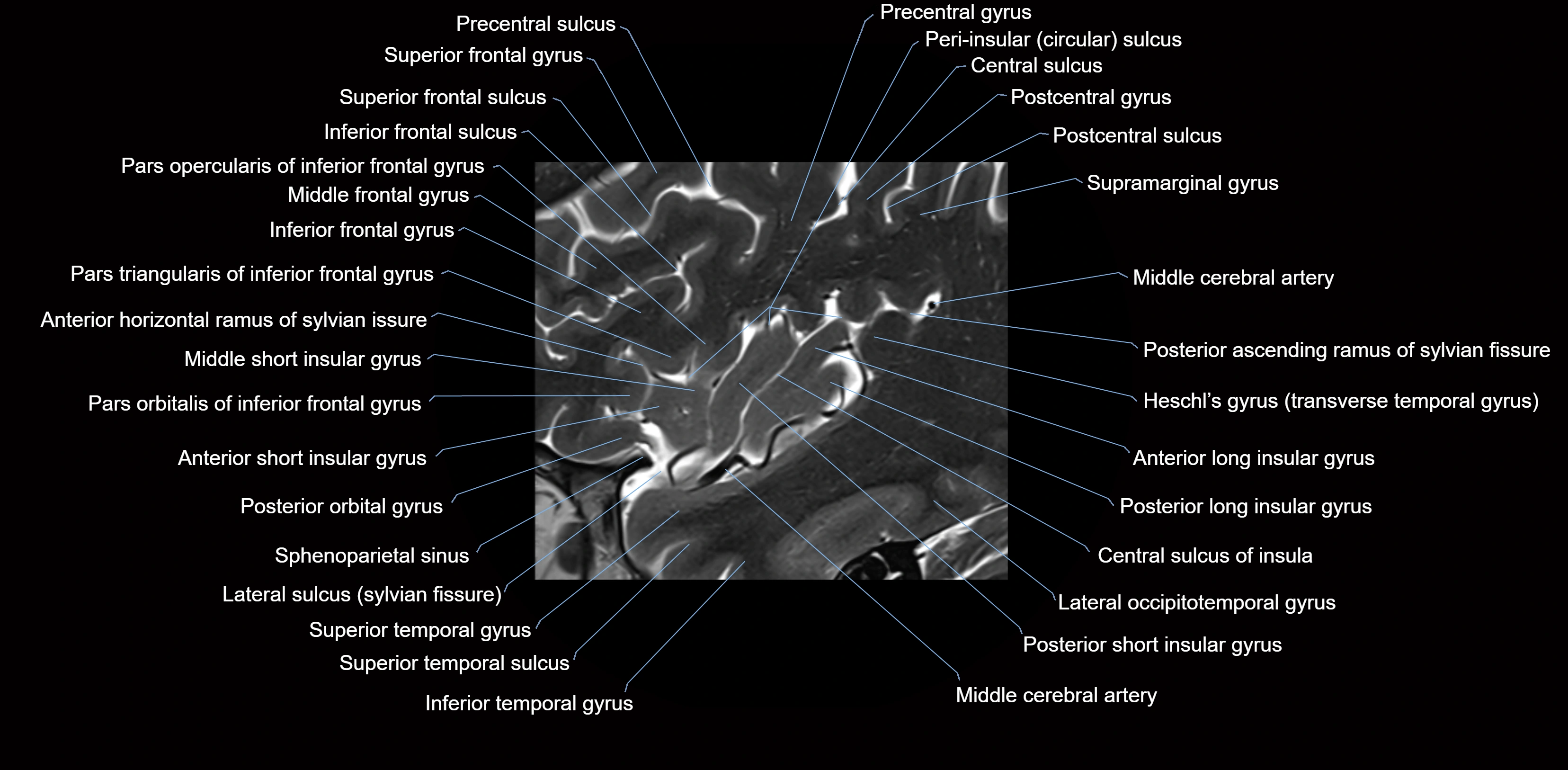 Insula cross section anatomy MRI sagittal 3t labelled image-img-00005.webp